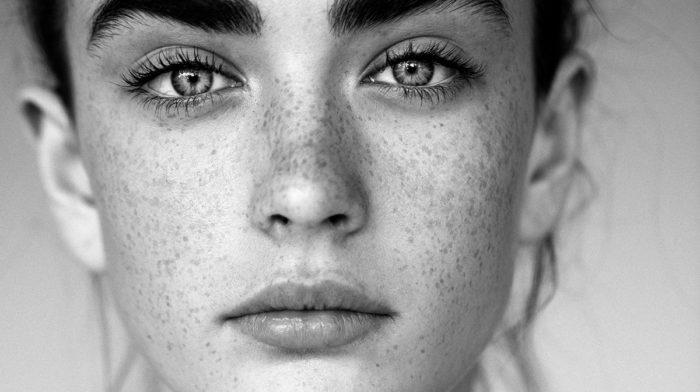 How to treat Hyperpigmentation and Age Spots Quickly