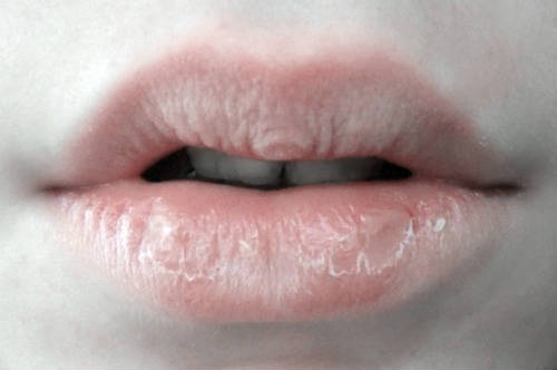 dry-lips