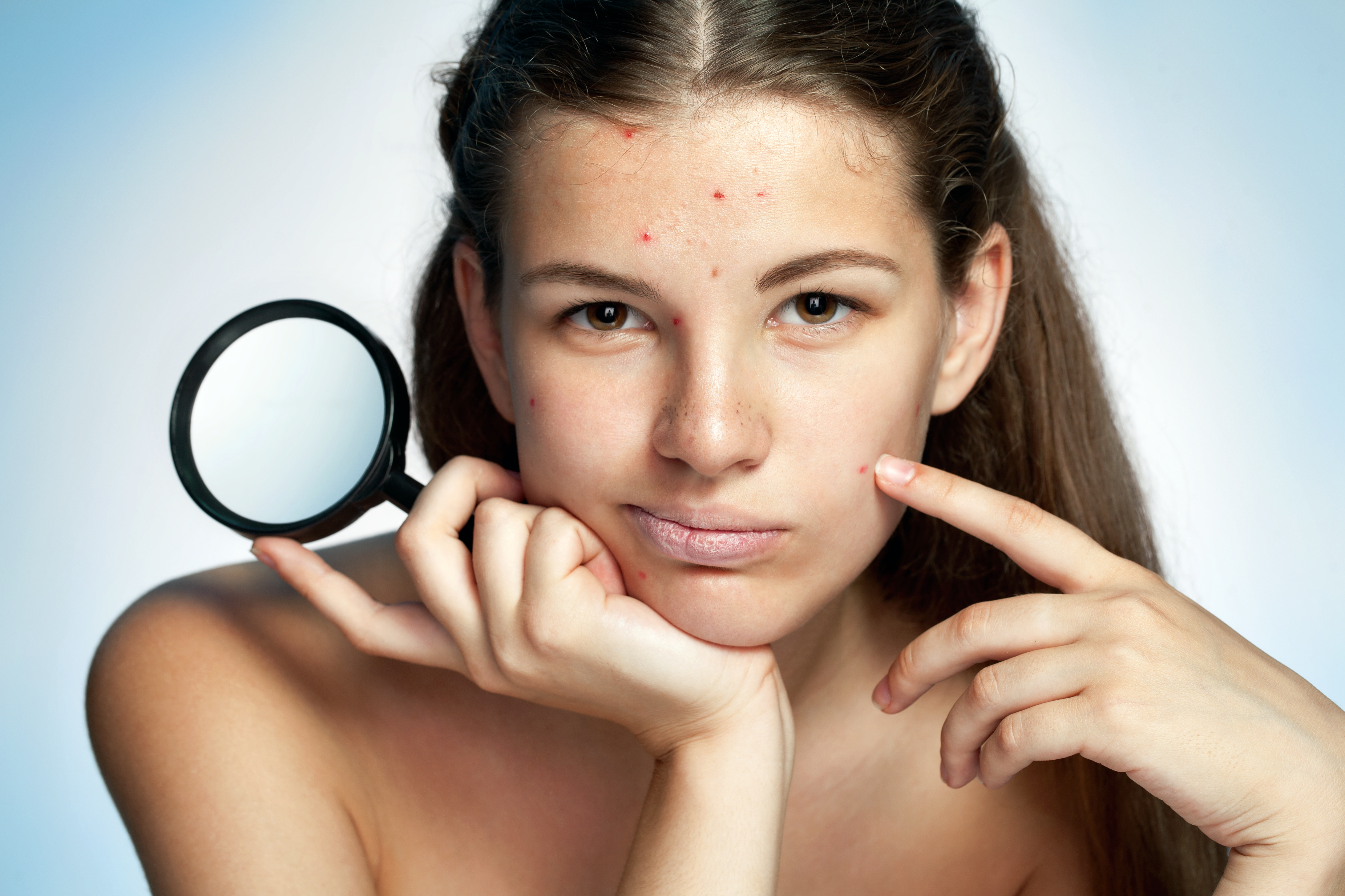 Teen girl with problem skin, pimple, magnifying glass.