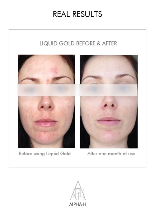 What is Liquid Gold and how to use it