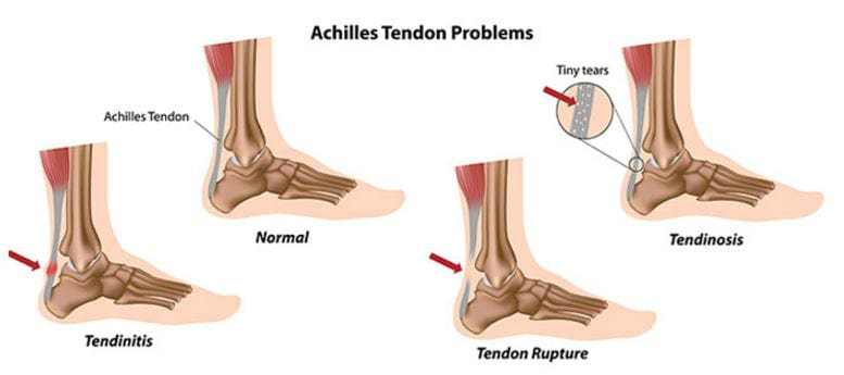 Тендинит ахиллова сухожилия лечение. Ахиллесова пята в медицине. Гомеопатия и разрыв сухожилия. Киста в ахилловом сухожилии. Реруптура это ахиллова сухожилия.