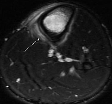 MRI scan of Medial Tibial Stress Syndrome (Shin splints)