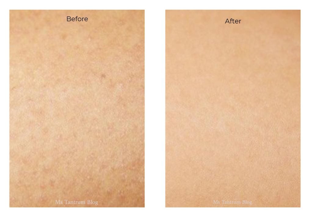 keratosis pilaris before and after