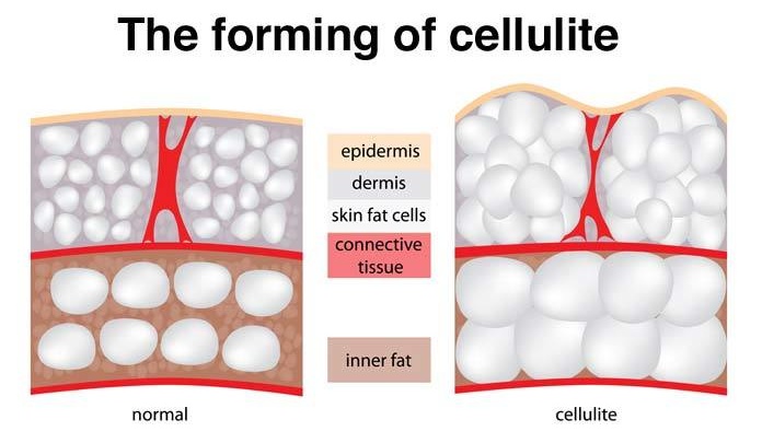 cellulite forming