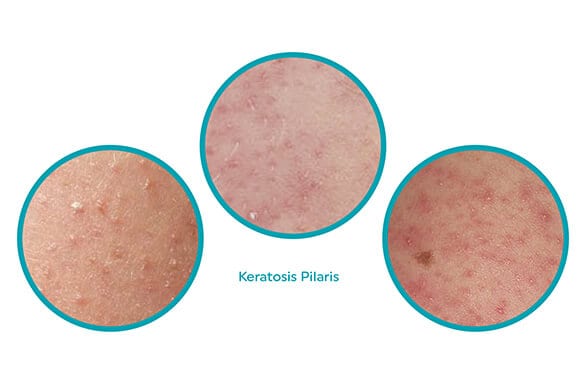 Keratosis pilaris deals causes