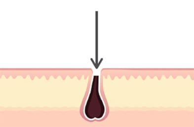 Hair follicle after shaving