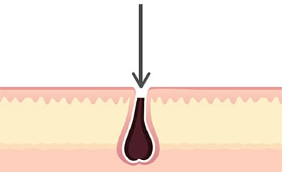 Hair follicle after close shave